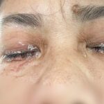 Cách xử lý keo 502 dính vào mắt an toàn và hiệu quả ngay tại nhà cách xử lý keo 502 dính vào mắt