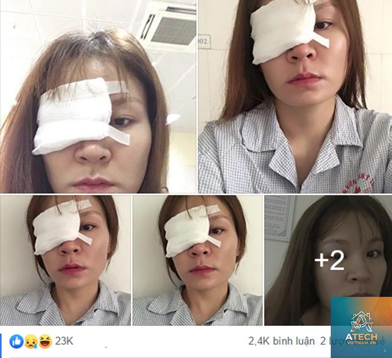 cách xử lý keo 502 dính vào mắt - Hình 2